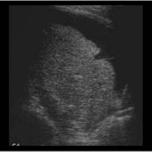 Chấn thương lách