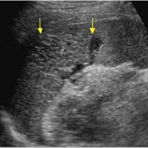 Chấn thương lách