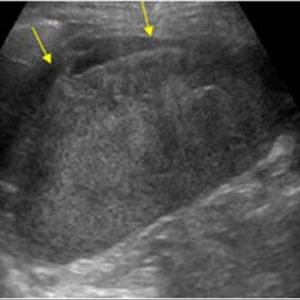 Chấn thương lách