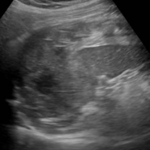 Chấn thương lách