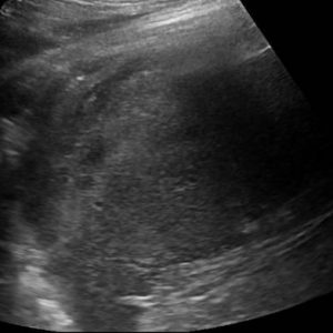 Chấn thương lách