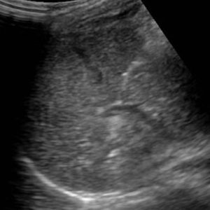 Chấn thương lách