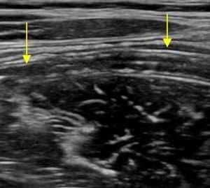 Ruột thừa bình thường