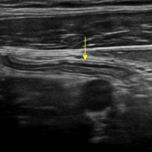 Ruột thừa bình thường