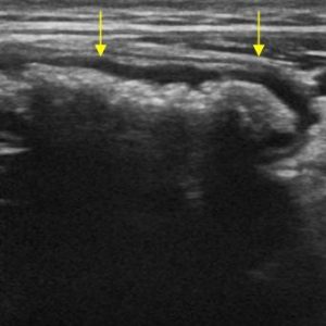 Ruột thừa bình thường