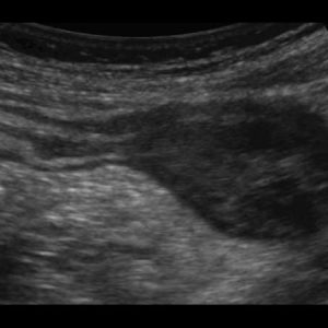 Mucocele ruột thừa