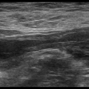 Mucocele ruột thừa