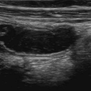 Mucocele ruột thừa