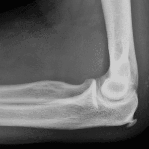 Chấn thương khuỷu tay