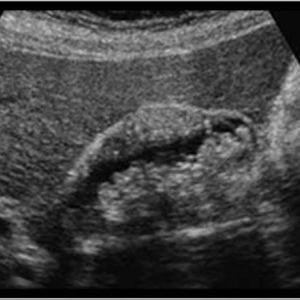 U cơ tuyến túi mật