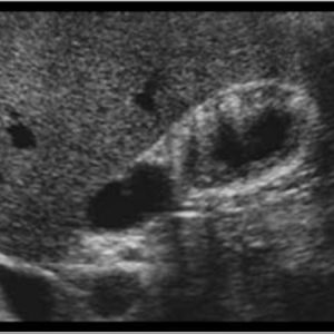 U cơ tuyến túi mật