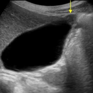 U cơ tuyến túi mật