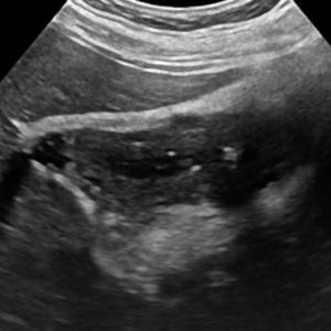 U cơ tuyến túi mật