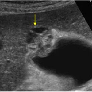 U cơ tuyến túi mật