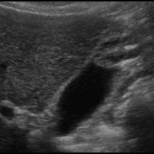 U cơ tuyến túi mật