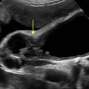 U cơ tuyến túi mật