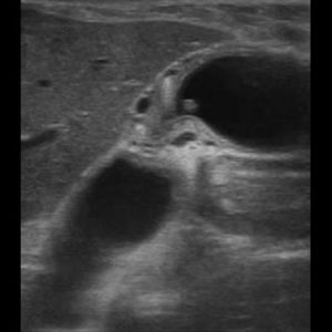 U cơ tuyến túi mật