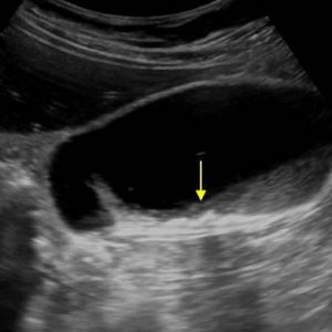 Sỏi bùn túi mật