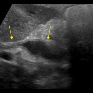 Viêm đường mật