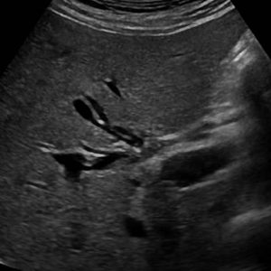 Viêm đường mật