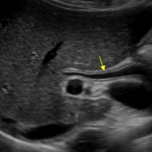 Viêm đường mật