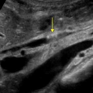 Khí đường mật