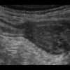 Mucocele ruột thừa - Ảnh 2