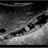 Polyp túi mật - Ảnh 2