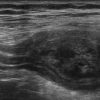 Mucocele ruột thừa - Ảnh 3