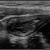 Crohn - Hình ảnh 3