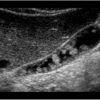 Polyp túi mật - Ảnh 3