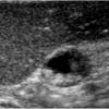 Polyp túi mật - Ảnh 4