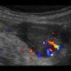 Mucocele ruột thừa - Ảnh 5