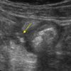 Crohn - Hình ảnh 5