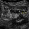 Crohn - Hình ảnh 5