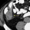 Mucocele ruột thừa - Ảnh 6