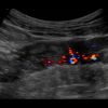 Crohn - Hình ảnh 6