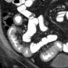 Crohn - Hình ảnh 8