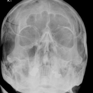 Vỡ xương hộp sọ