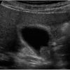 Polyp túi mật - Ảnh 2