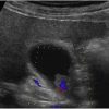 Polyp túi mật - Ảnh 4