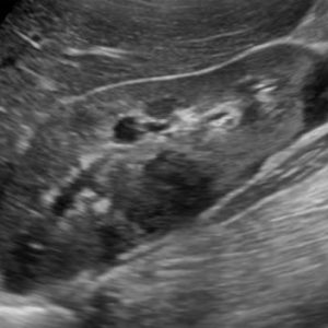 Lymphoma thận