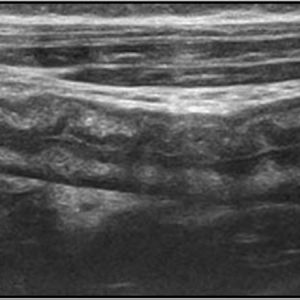 Viêm loét đại tràng