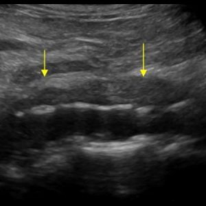 Xơ hóa sau phúc mạc