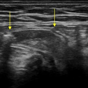 Thoát vị thành bụng
