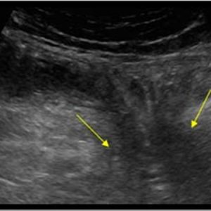 Thoát vị thành bụng