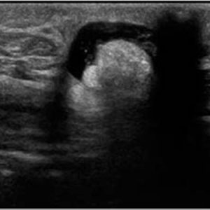 Thoát vị thành bụng