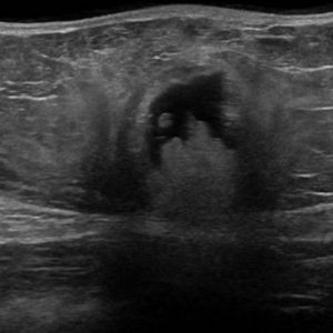 Thoát vị thành bụng