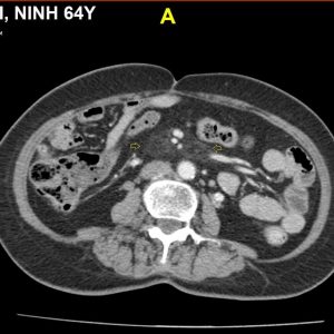 Viêm mỡ mạc treo