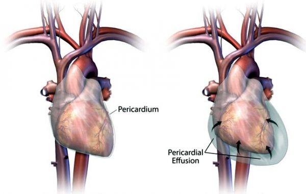 Tràn dịch màng tim [148 cases]